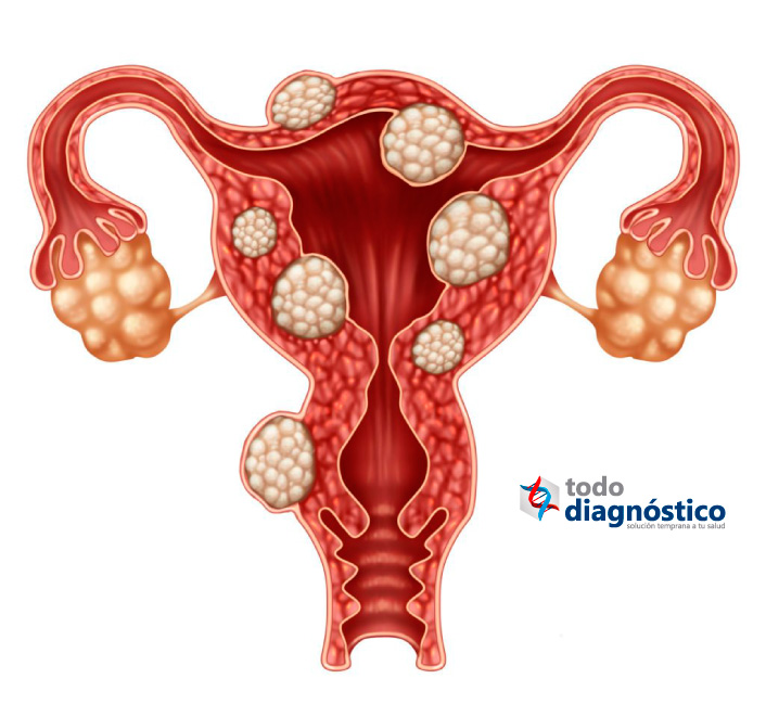 Enfermedades mal diagnosticadas más comunes: endometriosis