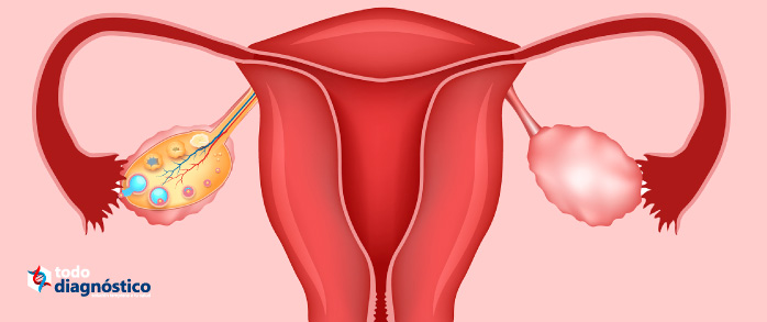 Enfermedades mal diagnosticadas más comunes: síndrome del ovario poliquístico