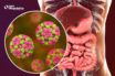 Infección por norovirus