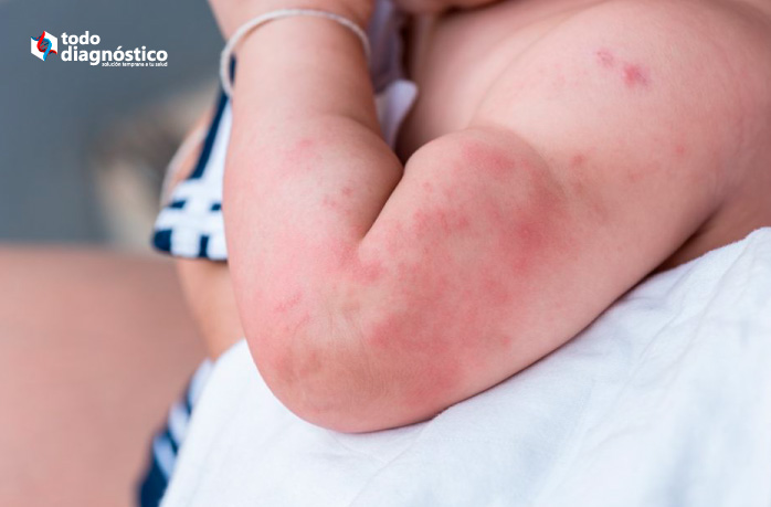 Uso innecesario de antibióticos en niños: reacción alérgica cutánea por antibióticos