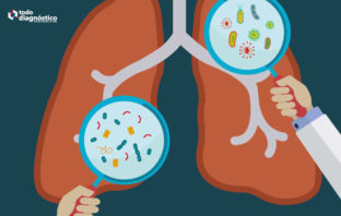 Bacterias atípicas en pulmones: neumonía por mycoplasma pneumoniae