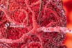 Diagnóstico Oportuno de la Sepsis